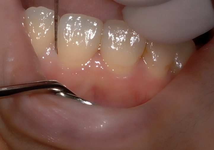 Magnified surgical view